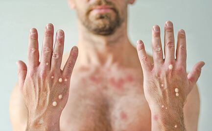 Viruela del mono: Emergencia de salud internacional