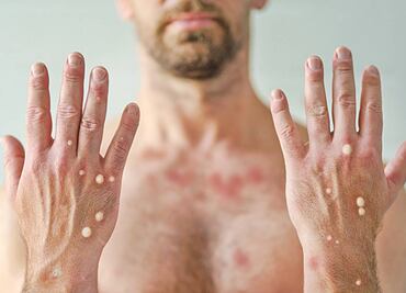 Viruela del mono: Emergencia de salud internacional