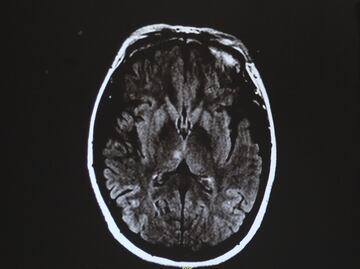 La curación de lesiones cerebrales podría relacionarse con un tipo de cáncer