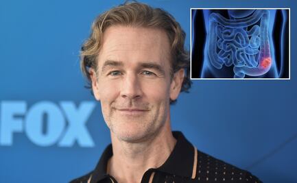 James Van Der Beek: ¿qué es el cáncer colorrectal, la enfermedad que padecía el actor?; conoce sus principales síntomas