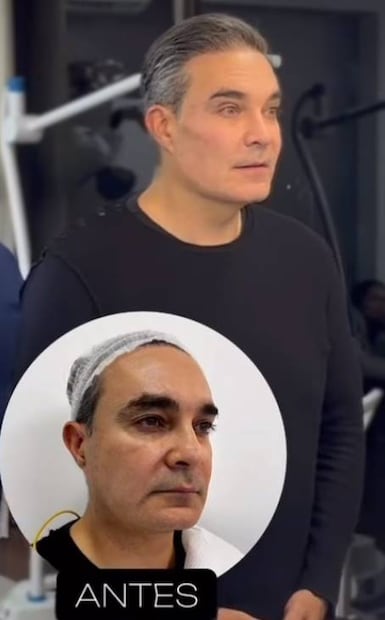 El antes y después del rostro de Mauricio Islas.