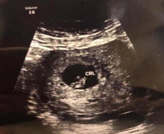 Viuda de Purón Johnston revela que está embarazada