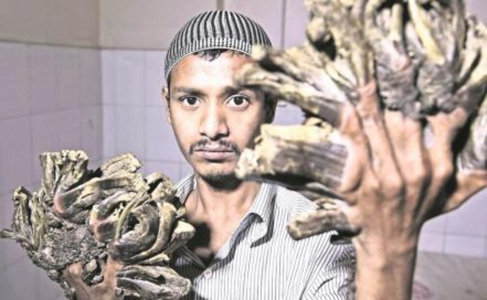 El "hombre árbol" ya fue operado