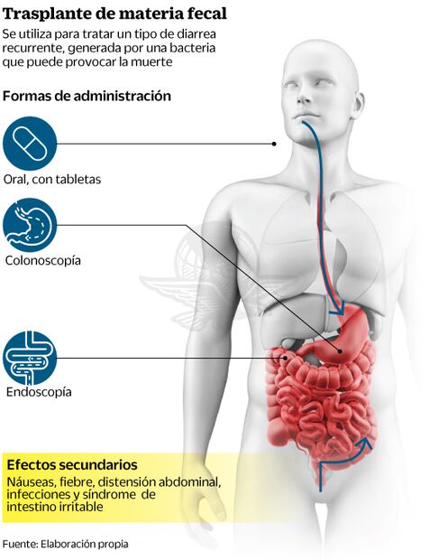 Eliminan diarrea, con trasplante de materia fecal