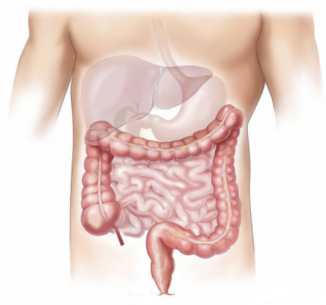 Conce cuales son los síntomas del cáncer de colon. Foto: Especial