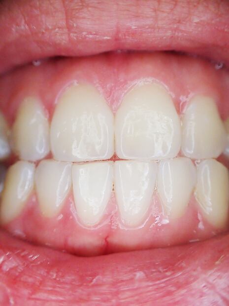 Dientes blancos. Fuente: Pixabay