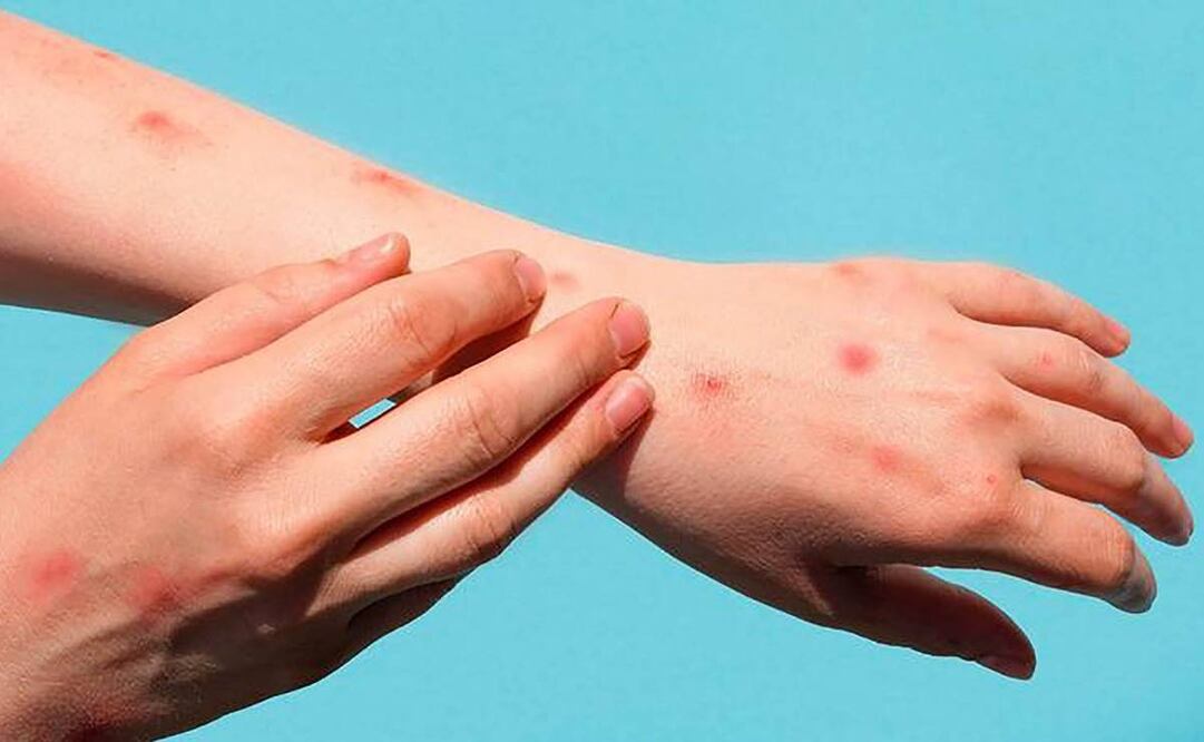 Estas son las diferencias entre el sarampión y varicela. Foto: Archivo / EL UNIVERSAL