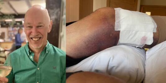 Rascarse le costó la vida: el hombre que murió por una bacteria carnívora en Turquía