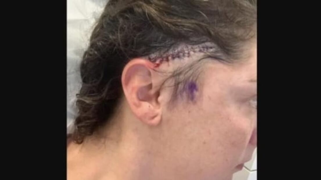 Fue a cortarse el pelo y la estilista le salvó la vida tras detectar una mancha
