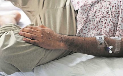 Especialista no ve señales de alarma por mpox en México con 72 casos   