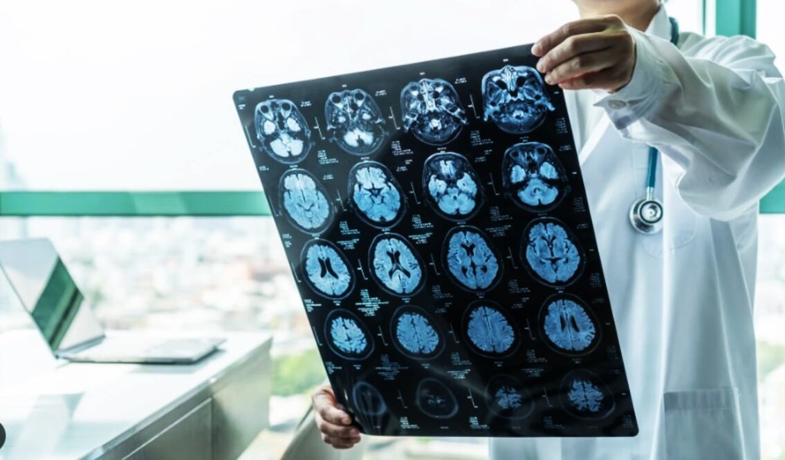 El origen del Alzheimer es asociado con la presencia excesiva de la proteína beta amiloide.
Foto: Archivo