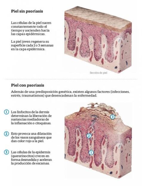 Lo que debes saber sobre la psoriasis