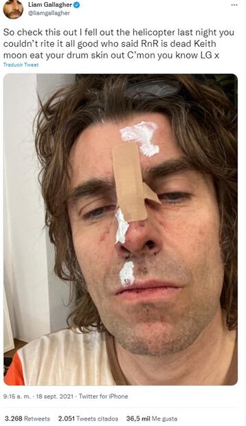 La extraña foto de Liam Gallagher herido tras "caer de un helicóptero"
