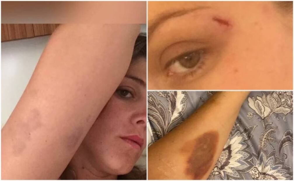 Natalia Alcocer muestra la violencia de su expareja: "Soy el anuncio de un feminicidio", advierte