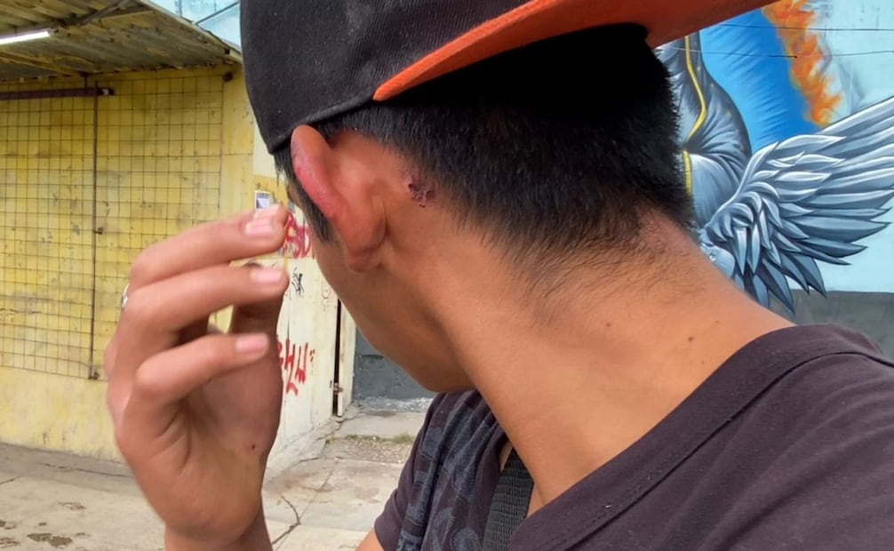 El joven sufrió quemaduras en un brazo y atrás de una oreja.
Foto: Emilio Fernández