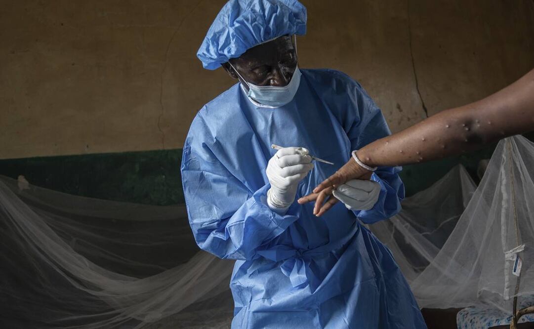 La OMS declaró emergencia de salud pública de alcance internacional por mpox el 14 de agosto de 2022 ante la rápida propagación de la enfermedad. Foto: AP