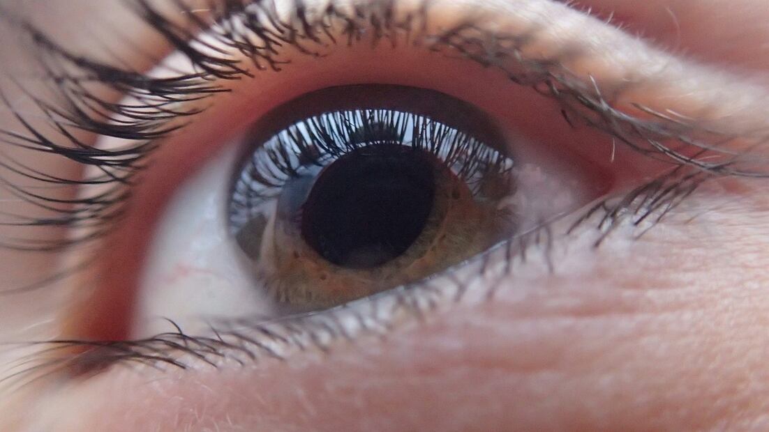 Glaucoma. Fuente: Pixabay