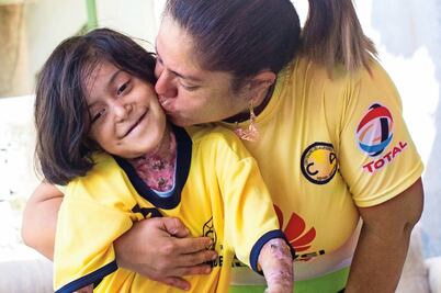 Historia. Purita, una niña con “piel de mariposa”
