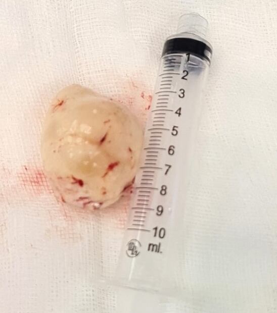 Iba por la vesícula; le retiran tumor del tamaño de un huevo