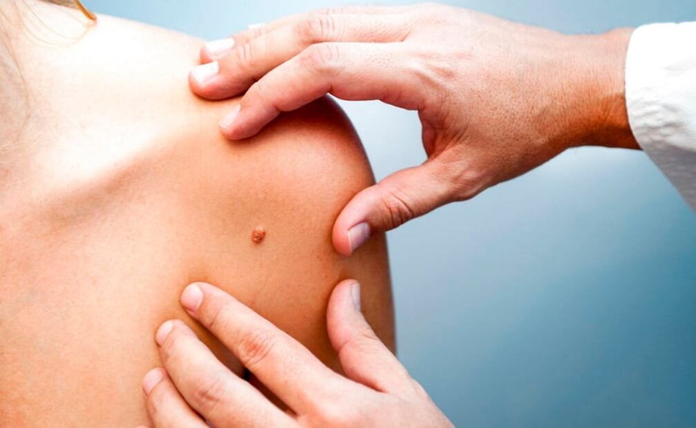 Síntomas del cáncer de piel. FOTO: Pexels