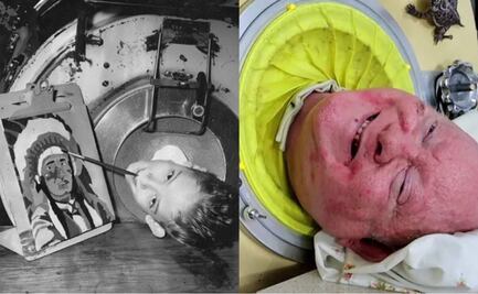 Paul Alexander: ¿Qué es la poliomielitis, enfermedad que contrajo hombre que vivió 70 años en un "pulmón de acero"?