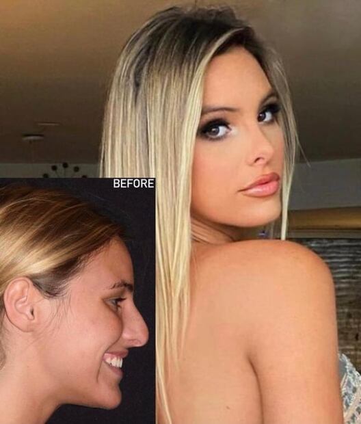 Lele Pons: esta es la cirugía que le cambió la vida a la sobrina de Chayanne