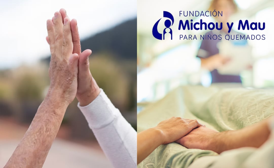 La Fundación Michou y Mau ofrece atención médica para pacientes con quemaduras severas. Foto: Fundación Michou y Mau