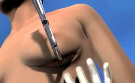 Muere mujer durante liposucción y aumento de senos en Puebla