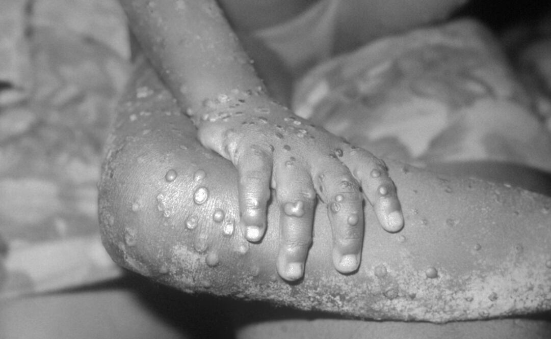 La OMS declaró haber recibido informes de casos de mpox (antes conocida como "viruela del mono") procedentes de 26 países en el último mes. Foto: Archivo/El Universal