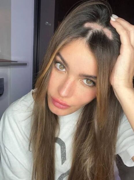 Génesis Aleska, exnovia de Nicky Jam, muestra impactantes fotos de su alopecia por ansiedad