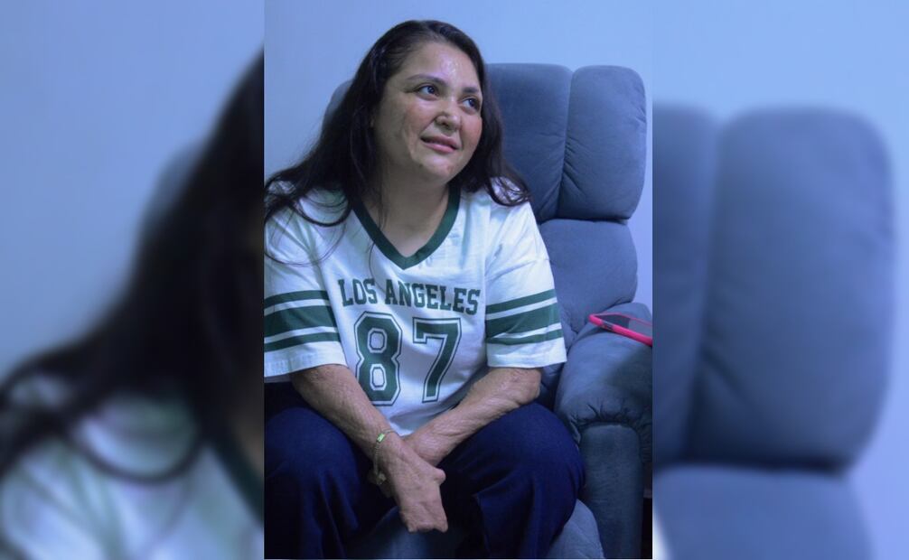 Le amputaron nueve dedos de sus manos y ha sido operada 35 veces. Foto: Javier Escobar / EL UNIVERSAL