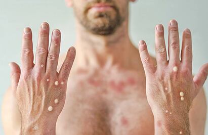 Edomex mantiene vigilancia epidemiológica por viruela símica; se tienen detectados 55 casos