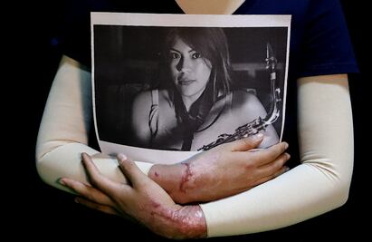 Atrae CNDH caso de saxofonista atacada con ácido en Oaxaca