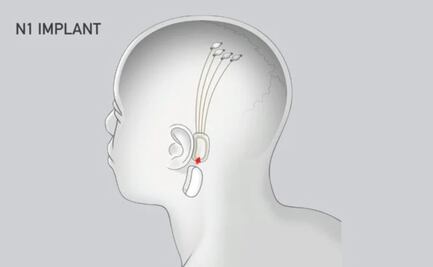 Elon Musk busca reproducir música en tu cerebro con Neuralink