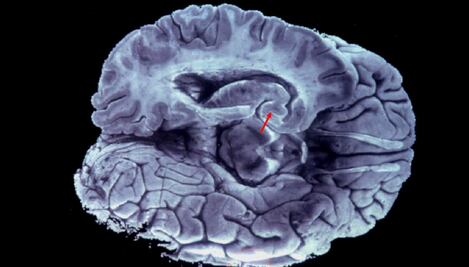 Nuevo tratamiento anti-Alzheimer arroja resultados esperanzadores en pacientes en etapa avanzada 