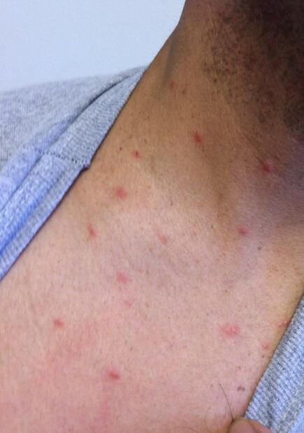 Picadura de chinches. Fuente: Twitter @montserdze