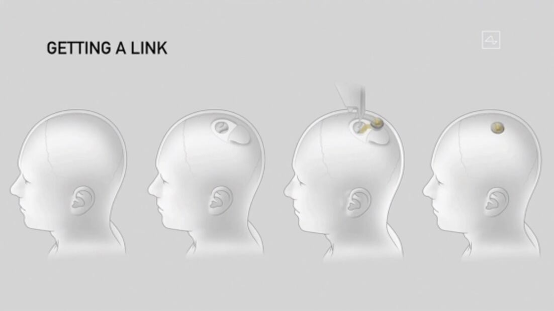 ¿Hacia dónde va y de dónde viene Neuralink?