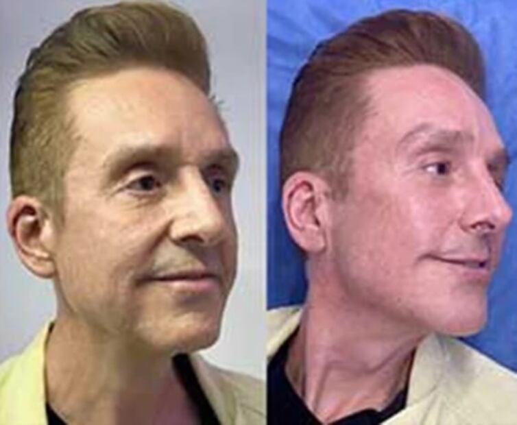 Daniel Bisogno se sometió a rejuvenecimiento facial, este fue el resultado 