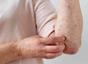 México suma 2 mil 901 contagios de viruela símica