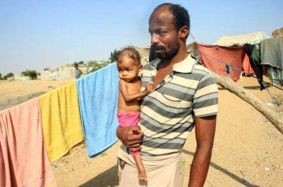 Randa, la niña de 3 años que pesa 4 kilos y está al filo de la muerte por desnutrición en Yemen