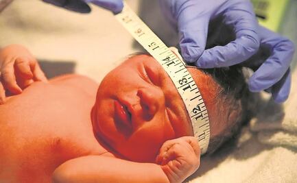 Craneosinostosis: afecta a uno de cada 2 mil bebés