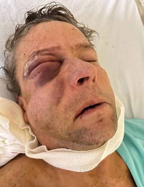 FOTOS: Así quedó Alfredo Adame tras cirugía: "Con un paracetamol quedo", dice