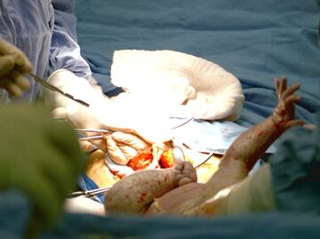 Los bebés nacidos por cesárea son más propensos a ser obesos