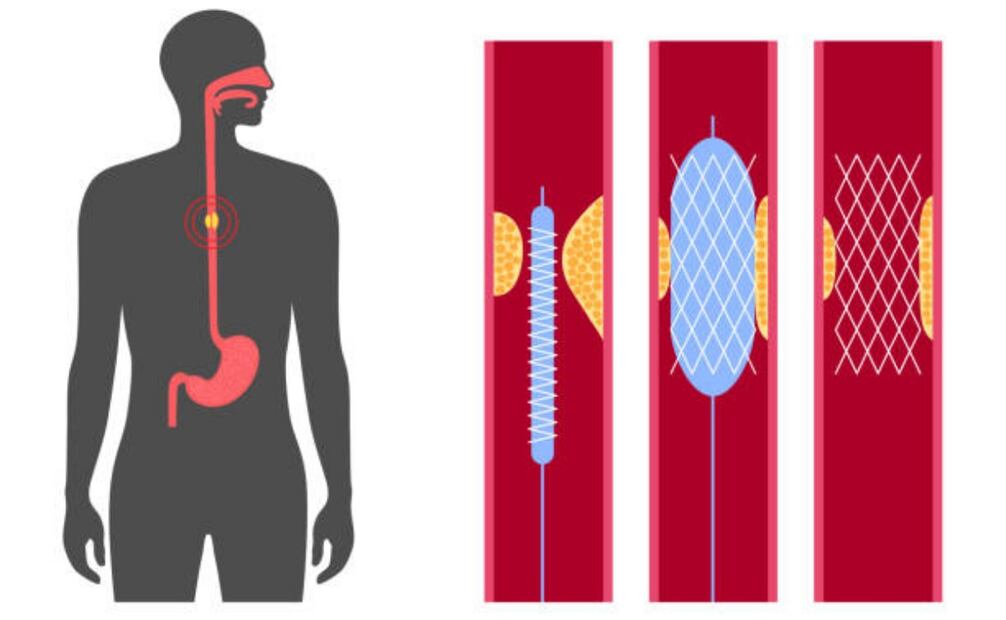 El stent es un tubo que mantiene el esófago abierto, permitiendo la deglución. Este procedimiento es una alternativa efectiva y menos invasiva que la cirugía, aunque puede presentar algunos riesgos menores. (25/12/24) Foto: iStock