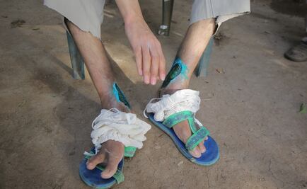 Tenía ámpulas y el agua le ocasionó enormes llagas