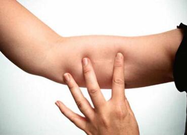Colocarán implantes anticonceptivos gratuitos en Tláhuac; jornada será el 3 y 4 de julio