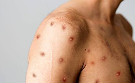 Confirman segundo caso de viruela del mono en Sinaloa