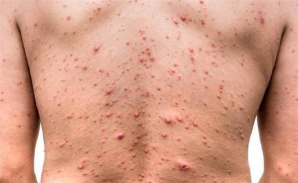 Confirman otro caso de viruela símica en Yucatán; ya suman 3 diagnósticos