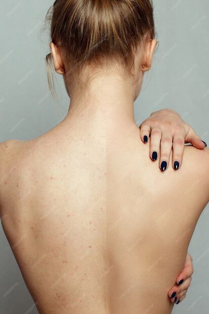 El acné es una de las afecciones de la piel más habituales. Fuente: Freepik.