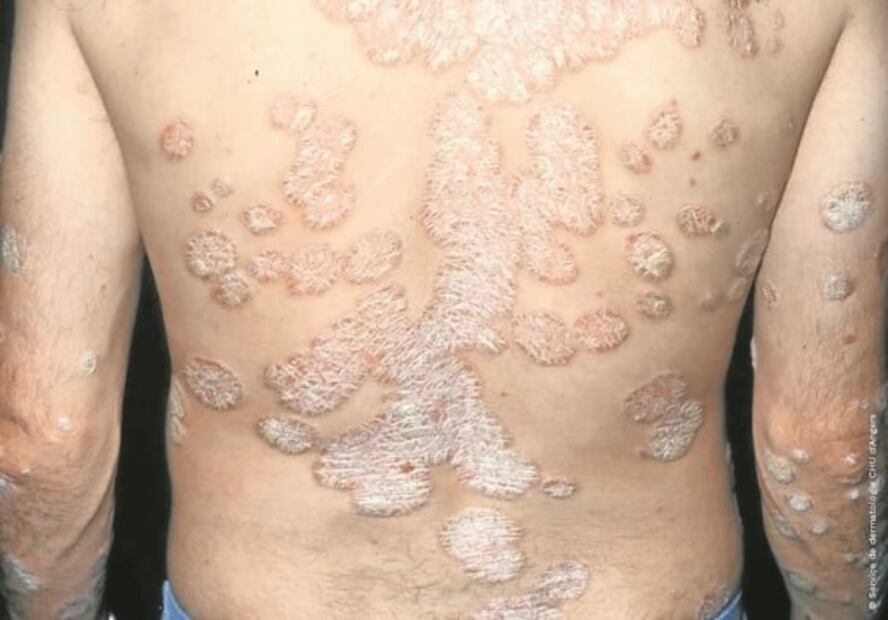 Psoriasis: tortura en la piel